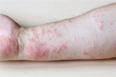 Itchy Rash On Side Of Forearm Close Up Stock Photo Download Image Now