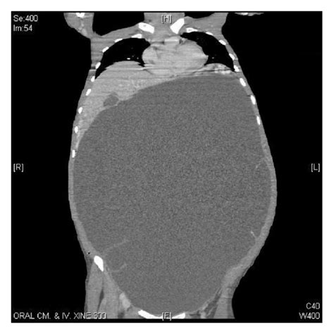 Axial And Coronal Computerized Tomography Ct Scan Images Showing A