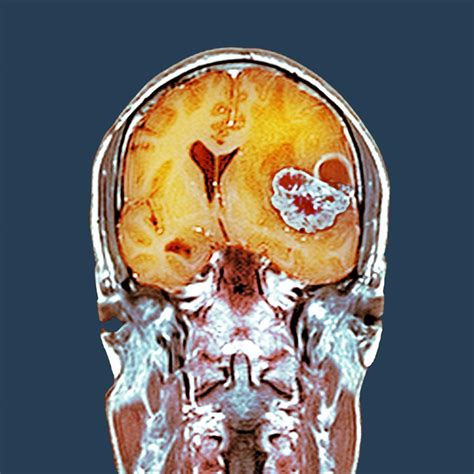 Brain Cancer Mri Scan Photograph By Science Photo Library