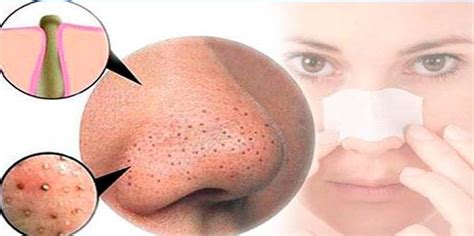How To Narrow Pores And Remove Black Spots On Your Face