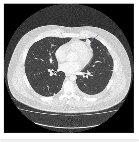 Ct Scan Chest May 2014 Relapsed Ewings Sarcoma In The Lungs With
