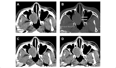 A Axial Ct Soft Tissue Window Shows The Density Shadow Of Nasal Soft