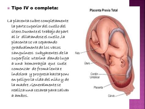 Low lying placenta:in this type placenta is extended placenta previa is generally diagnosed with routine ultrasound during the second trimester. materno infantil: placenta previa