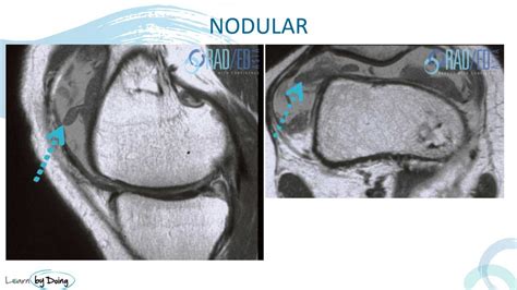 Synovitis Mri Findings Knee What Does It Look Like Radedasia