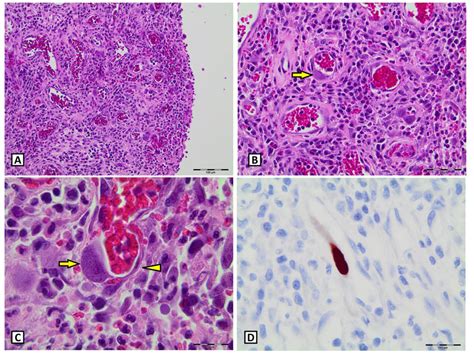 Cytomegalovirus Infection In Ulcerated Colonic Mucosa A B Affected
