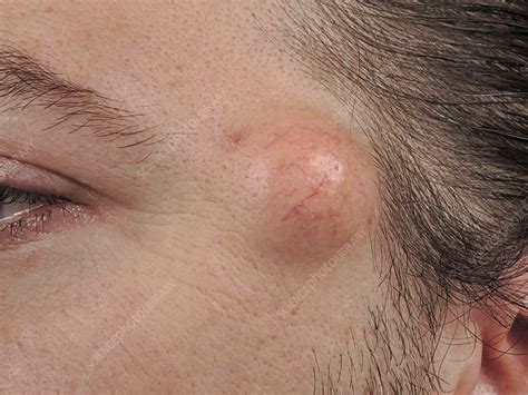 Sebaceous Cyst Stock Image C0464494 Science Photo