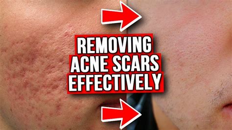 Get Rid Of Acne Scars From Experience Youtube
