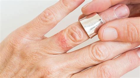 Eczema Symptoms Treatment Causes More
