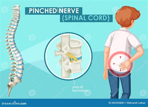 Diagram Showing Pinched Nerve Stock Vector Illustration Of Human