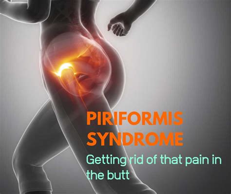 Piriformis Syndrome