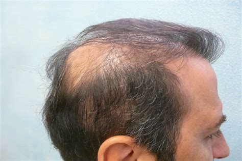 Hair Transplant For The Crown Before Or After A Hairline Restoration