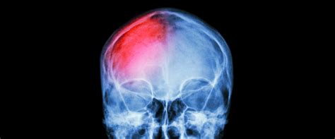 How Is Mild Traumatic Brain Injury Treated