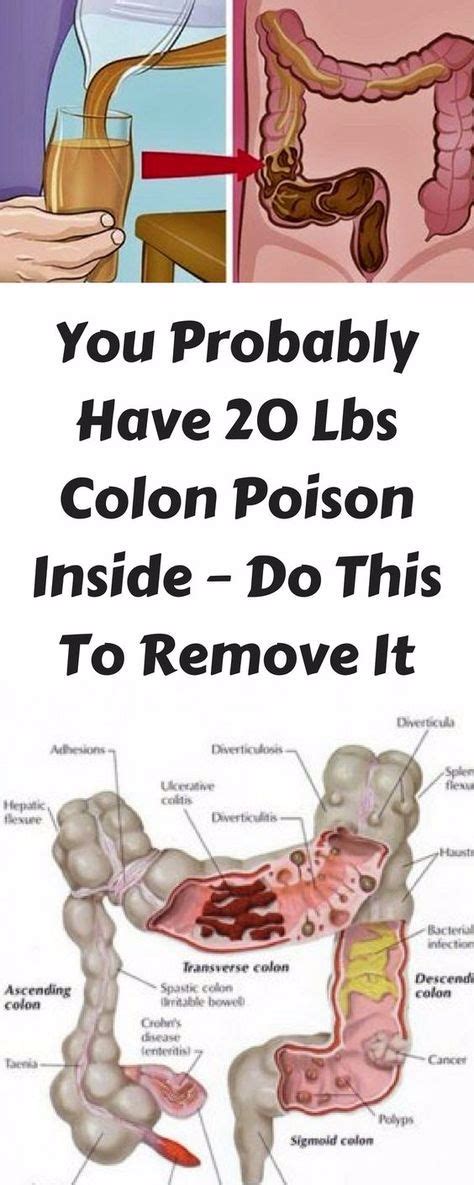 These 2 Homemade Colon Cleanse Recipes Help Eliminate All Deposited Toxins From The Colon