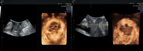 Pelvic Organ Prolapse Diagnosis With 3D Ultrasound Imaging Empowered