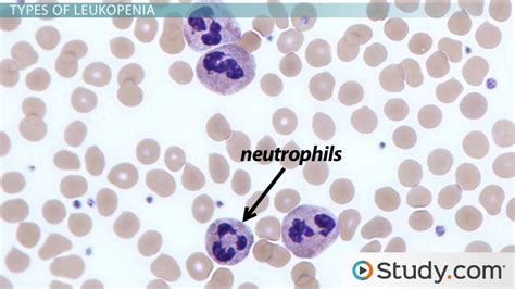 What Is Leukopenia Causes And Types Video And Lesson Transcript
