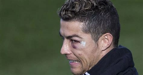 Cristiano Ronaldo Shows Off Cool Scar And Black Eye In Training Session