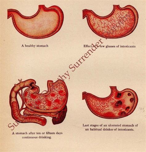 Four Different Types Of Stomachs Are Shown In This Vintage Medical
