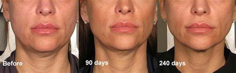 Theleafvacuum Ultherapy Jowls Before And After