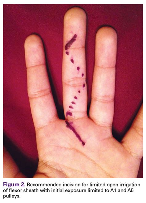 5 Points On Pyogenic Flexor Tenosynovitis Of The Hand Mdedge Surgery