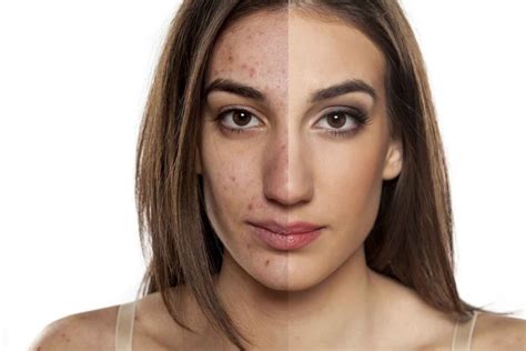 How To Get Rid Of Acne Scars Myskyn