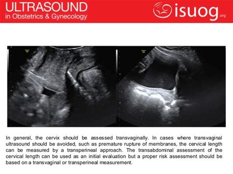 How To Measure Cervical Length Cervical Transvaginal Ultrasound