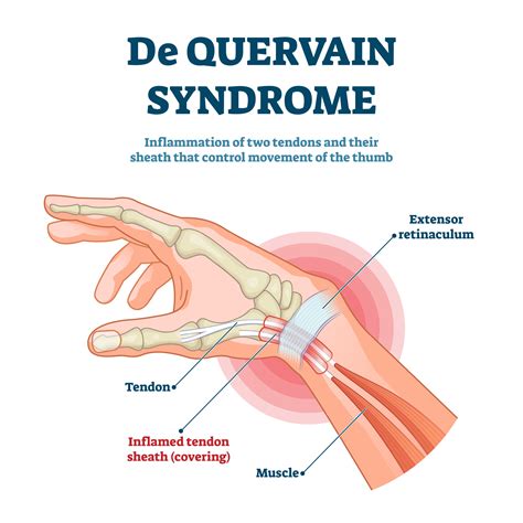 De quervain tenosynovitis is thickening of the fibrous sheaths of two tendons at the base of the thumb, the abductor pollicis longus (apl) and extensor pollicis brevis (epb). De Quervain's Disease: A Closer Look | Kansas City Bone ...