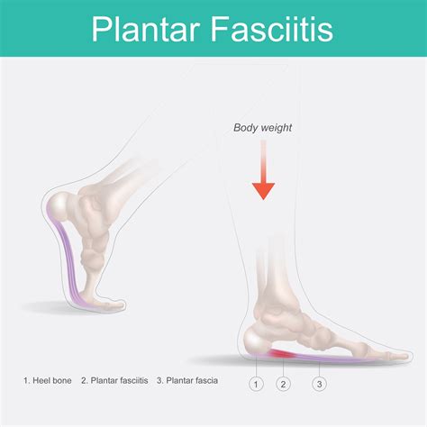 How Does Physical Therapy Help Plantar Fasciitishealth Plus Physical