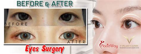 Before And After Double Eyelid Surgery In Pattaya Thailand