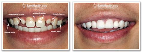 Your dentist will explain value. Veneers Without Grinding