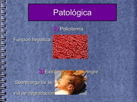 Ictericia Neonatal Por Hiperbilirubinemia No Conjugada