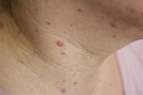 How To Treat Chicken Pox In Adults Livestrongcom