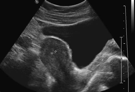 Transvaginal means across or through the vagina. Transabdominal ultrasound of the uterus | Download ...