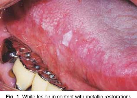 Figure From A Clinical Report Of An Oral Lichen Planus Associated To