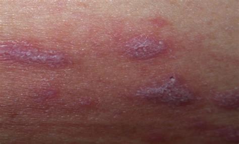Scaly Skin Eruptions Medical Care One