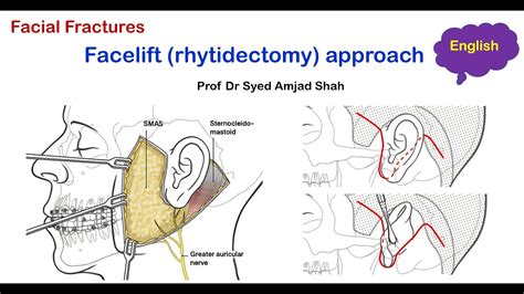 Facelift Rhytidectomy Approach English Oral Maxillofacial Surgery Syed Amjad Shah Youtube