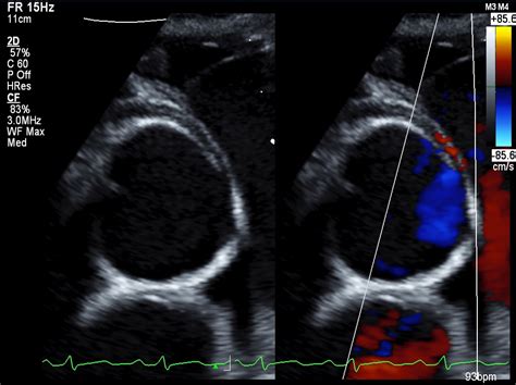 Sudden Cardiac Arrest And Anomalous Aortic Origin Of A Coronary Artery