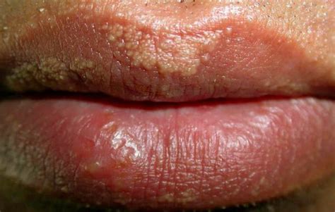 Bumps On Lips After Kissing Qqmcuo