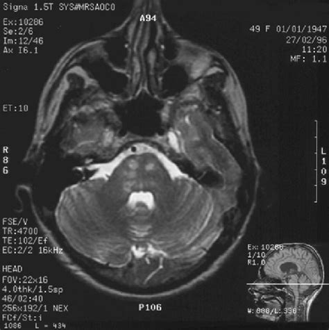 Axial T2 Weighted Mri Of The Brain Showing Multiple High Signal Lesions