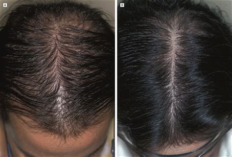 Some females may begin losing their hair. Finasteride Treatment of Female Pattern Hair Loss | JAMA ...