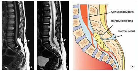 Spinal Cord Radiology Key