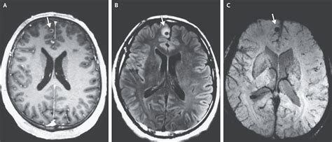 Medical Mystery Massachusetts Man Had Tapeworm Living In His Brain For