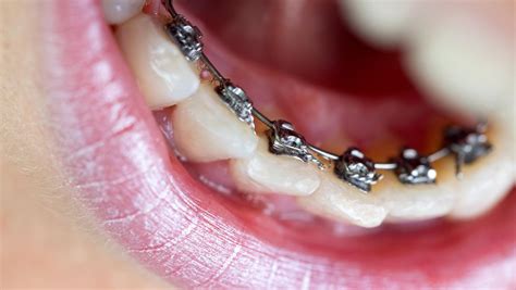 Lingual Braces Orthodontist Chalfont Invisalign Clear Braces Ottsville Pa