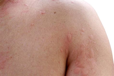 Self Reported Penicillin Allergy Could Be Chronic Hives