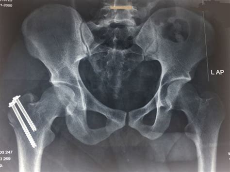 Cureus Traumatic Pubic Type Anterior Dislocation Of The Hip With An