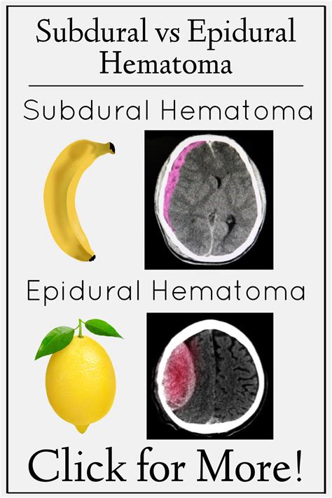 Subdural Vs Epidural Hematoma Ct Findings Location Symptoms And