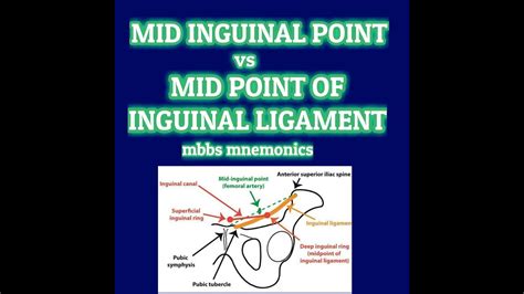 Mid Inguinal Point Vs Mid Point Of Inguinal Ligament Mbbs Mnemonics
