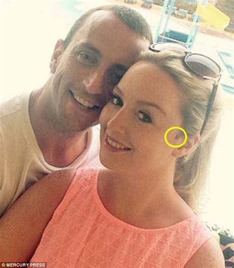 Gemma Cottam Reveals Scar From Her Ear To Her Chin After Melanoma Mole