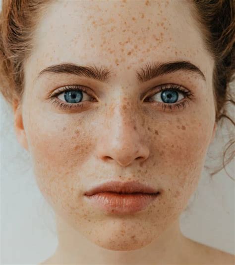 Reduce The Appearance Of Sun Damage And Freckles