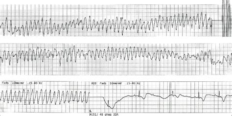 Ecg Shows Polymorphic Ventricular Tachycardia Torsade De Pointes