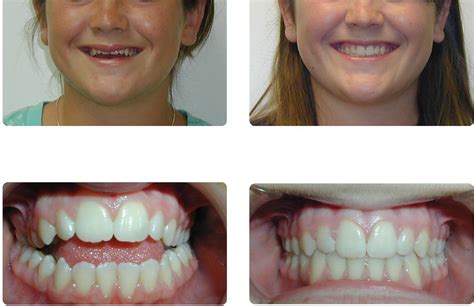 Orthodontic Before And After Photos Brodsky Orthodontics